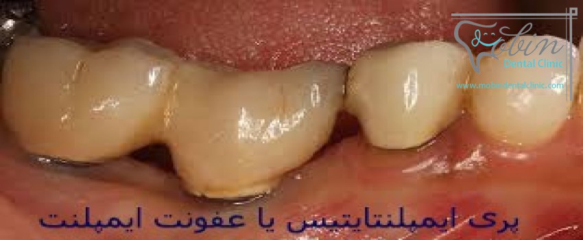 عفونت لثه از عوارض ایمپلنت دندان